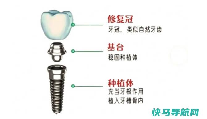 种牙多少钱一颗大概多少钱，5000元-30000元之间（不能报销）