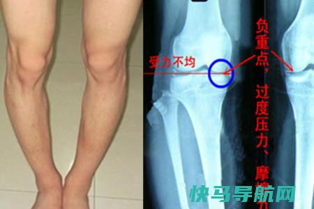 宝宝罗圈腿的判断及预防方法