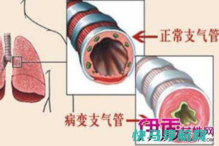 支气管炎的症状及治疗偏方