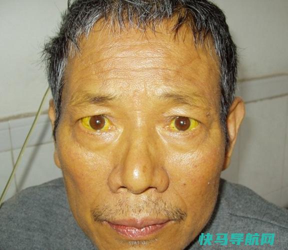 肝病全身发黄会有生命危险吗