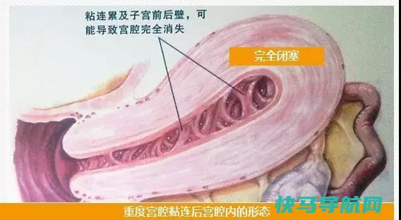 宫颈粘连手术后的饮食禁忌