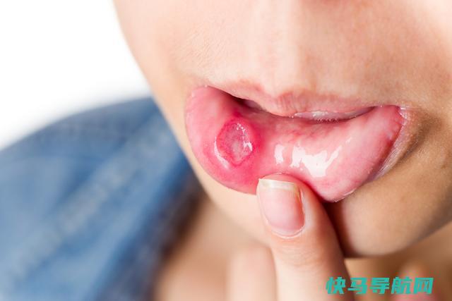 反复性的口腔溃疡是什么原因引起的？