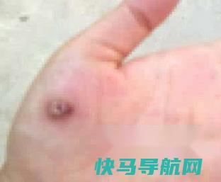 手上长鸡眼怎么根除