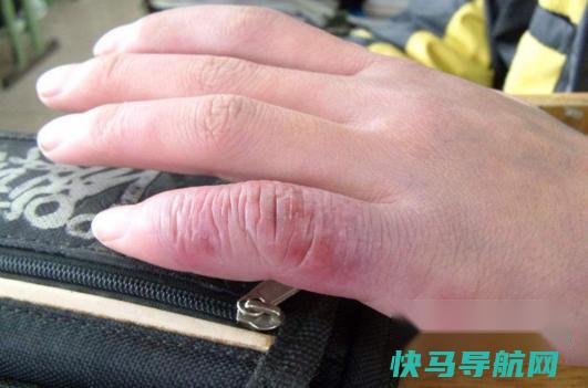 冻疮怎么根治